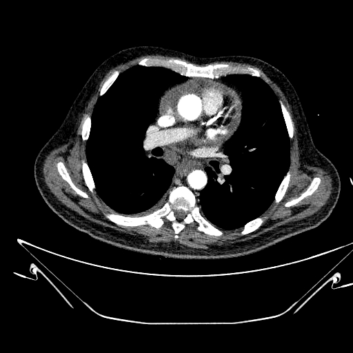 Aortic arch aneurysm (Radiopaedia 84109-99365 B 312).jpg
