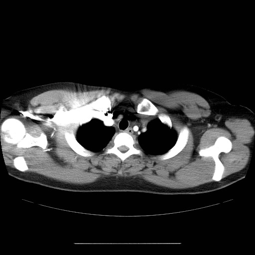 File:Aortic arch stent (Radiopaedia 30030-30595 D 3).jpg