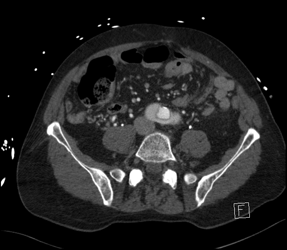 Aortic dissection (CTPA) (Radiopaedia 75506-86750 E 100).jpg