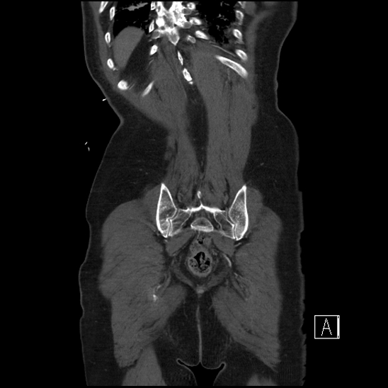 Aortic dissection (CTPA) (Radiopaedia 75506-86750 F 67).jpg