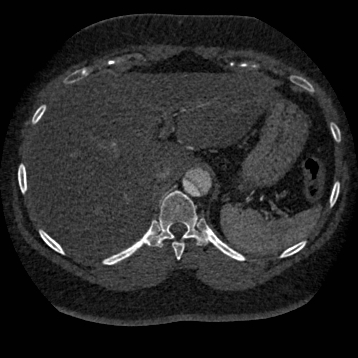 Aortic dissection (Radiopaedia 57969-64959 A 297).jpg