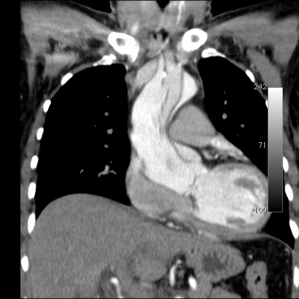 Aortic dissection - Stanford type A (Radiopaedia 29247-29659 B 25).jpg