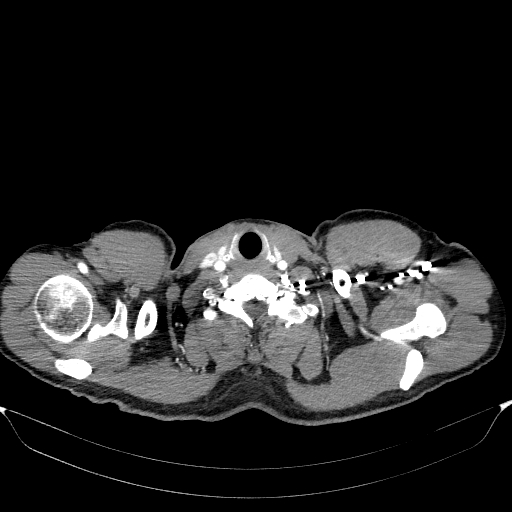 File:Aortic dissection - Stanford type A (Radiopaedia 83418-98500 A 1).jpg