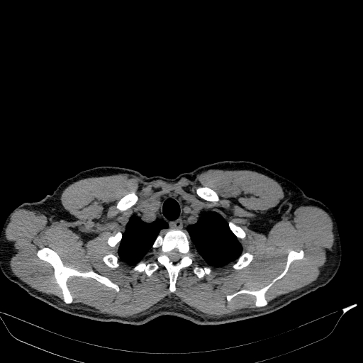 Aortic dissection - Stanford type A (Radiopaedia 83418-98500 Axial non-contrast 3).jpg