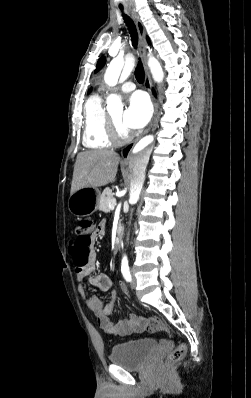 Aortic dissection - Stanford type A (Radiopaedia 83418-98500 B 39).jpg