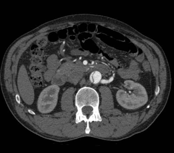 File:Aortic dissection - Stanford type B (Radiopaedia 73648-84437 A 152).jpg