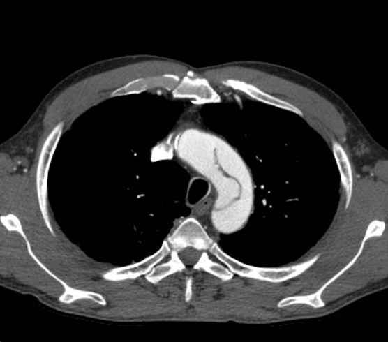 File:Aortic dissection - Stanford type B (Radiopaedia 73648-84437 A 18).jpg