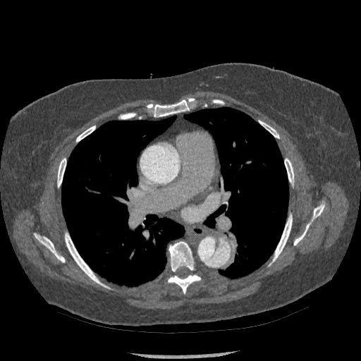 Aortic dissection - Stanford type B (Radiopaedia 88281-104910 A 39).jpg