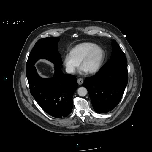 Aortic intramural hematoma (Radiopaedia 48463-53380 C 114).jpg