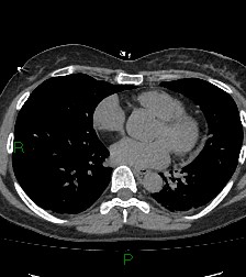 Aortic valve endocarditis (Radiopaedia 87209-103485 Axial non-contrast 62).jpg