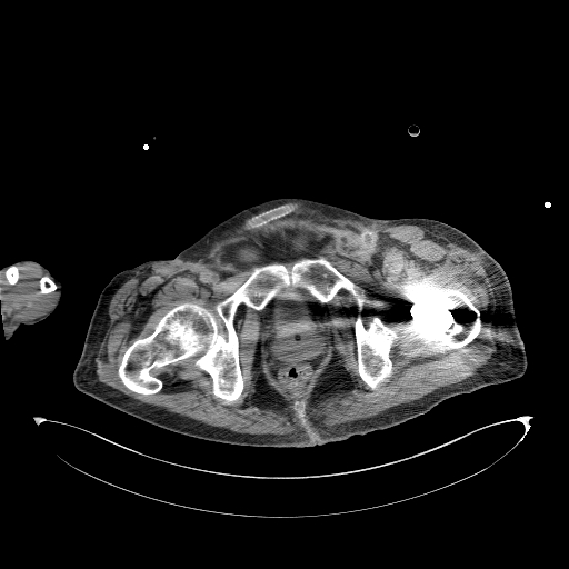 Aortoduodenal fistula (Radiopaedia 75286-86415 Axial non-contrast 76).jpg