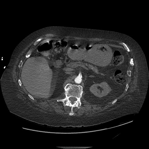 Aortoesophageal fistula with endovascular repair (Radiopaedia 73781-84592 Axial C+ CTPA 204).jpg