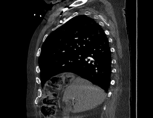 Aortoesophageal fistula with endovascular repair (Radiopaedia 73781-84592 Sagittal C+ CTPA 60).jpg