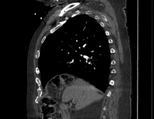 Aortoesophageal fistula with endovascular repair (Radiopaedia 73781-84592 Sagittal C+ CTPA 65).jpg