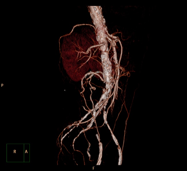 File:Aortoiliac occlusive disease (Radiopaedia 32134-33076 VR C+ arterial phase 4).jpg