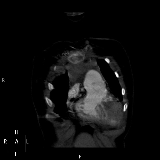 File:Aortopulmonary septal defect (Radiopaedia 41990-45013 Coronal C+ CTPA 3).jpg
