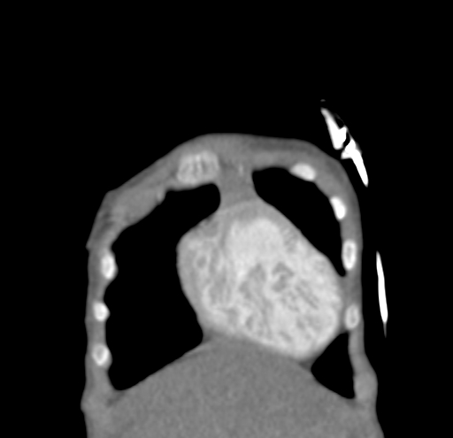File:Aortopulmonary window, interrupted aortic arch and large PDA giving the descending aorta (Radiopaedia 35573-37074 D 3).jpg