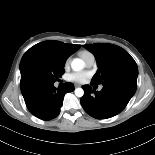 File:Apical pleural calcification (Radiopaedia 46141-50499 Axial C+ delayed 35).png