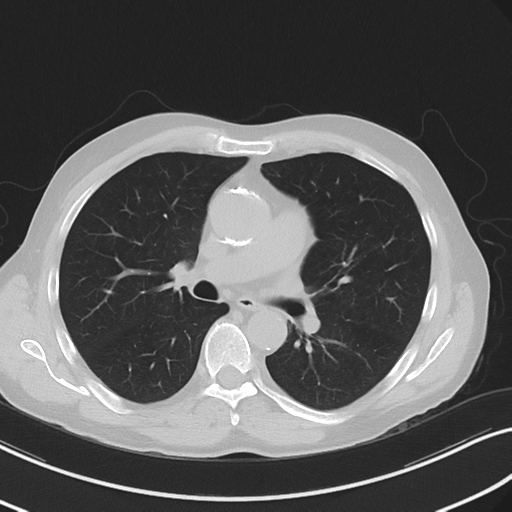 Apical pulmonary metastasis (Radiopaedia 46338-50754 Axial non-contrast 31).png