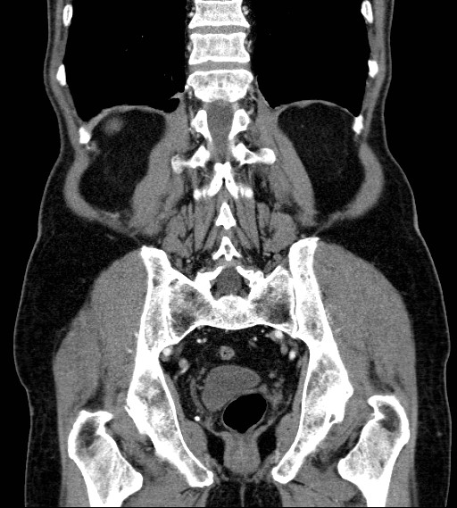 File:Appendiceal adenocarcinoma complicated by retroperitoneal abscess (Radiopaedia 58007-65039 A 67).jpg