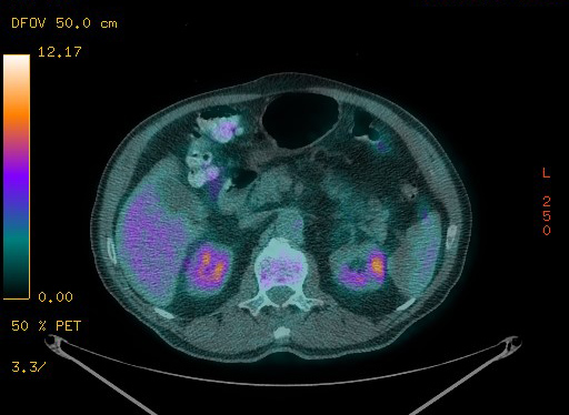 Appendiceal adenocarcinoma complicated by retroperitoneal abscess (Radiopaedia 58007-65041 Axial PET-CT 115).jpg