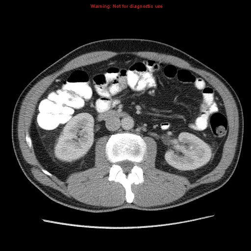 Appendicitis and renal cell carcinoma (Radiopaedia 17063-16760 A 26).jpg