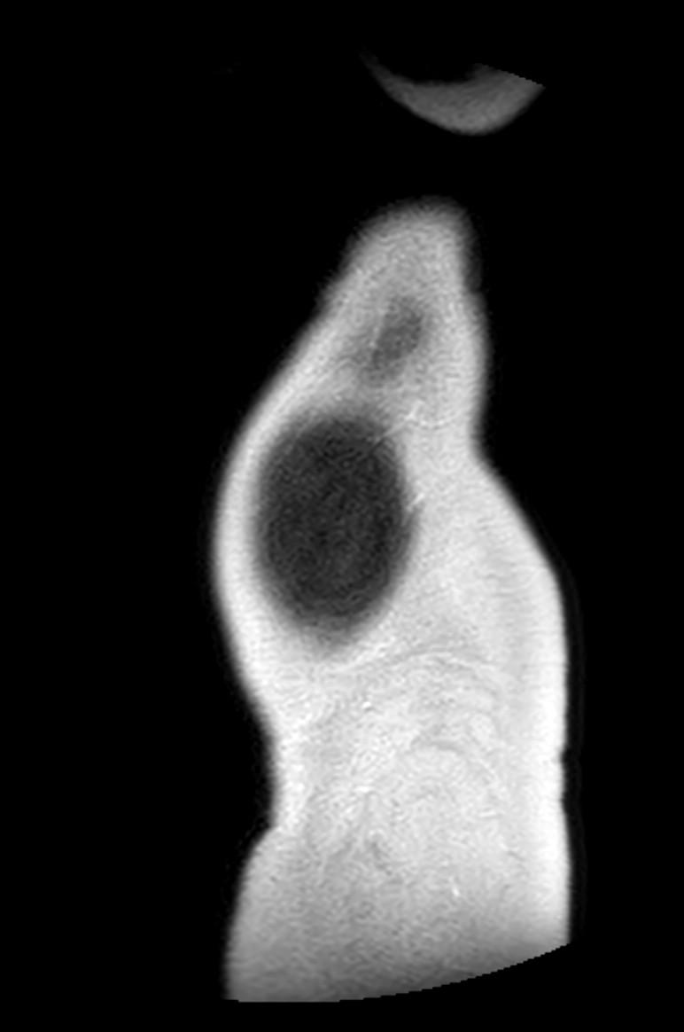 Appendicitis in gravida (MRI) (Radiopaedia 89433-106395 Sagittal T2 63).jpg
