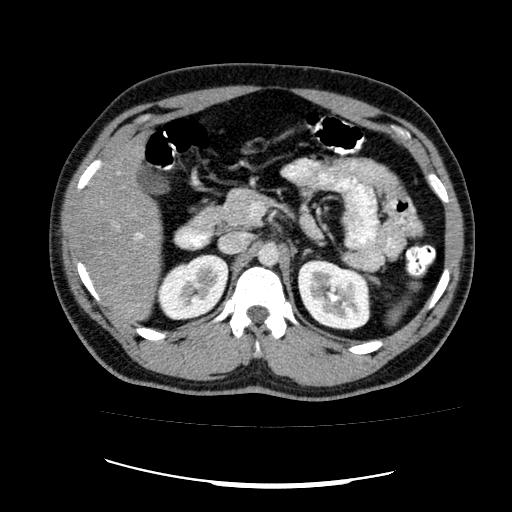 File:Appendicitis with diverticulosis (Radiopaedia 47693-52383 Axial C+ 45).jpg