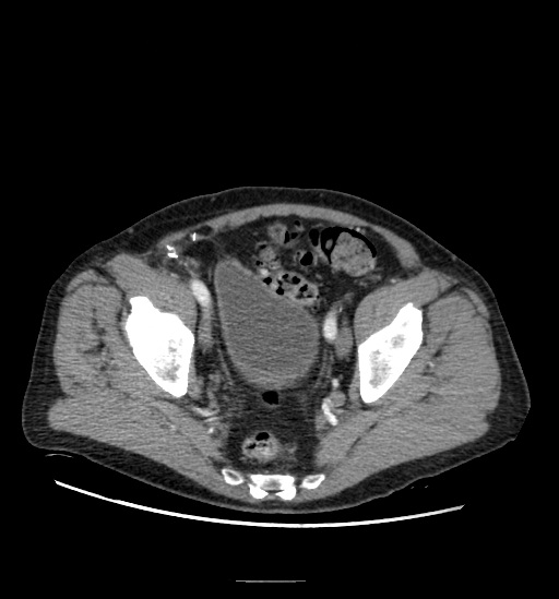 File:Appendicitis with localized perforation and abscess formation (Radiopaedia 49035-54130 A 75).jpg