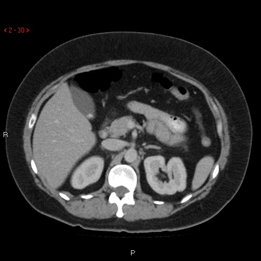 File:Appendicitis with microperforation- promontoric type (Radiopaedia 27268-27442 C 18).jpg