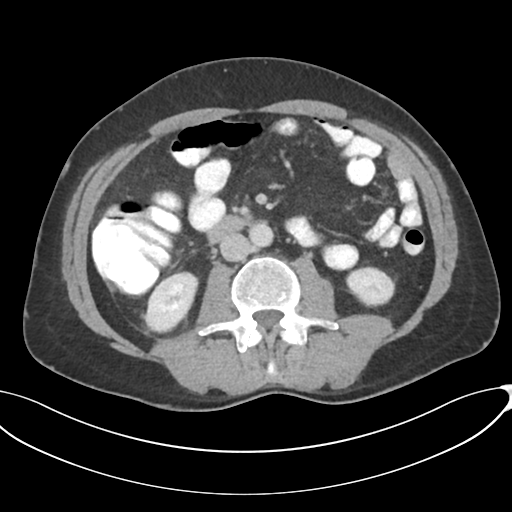 Appendicitis with thickening of the terminal ileum (Radiopaedia 42432-45550 A 49).png