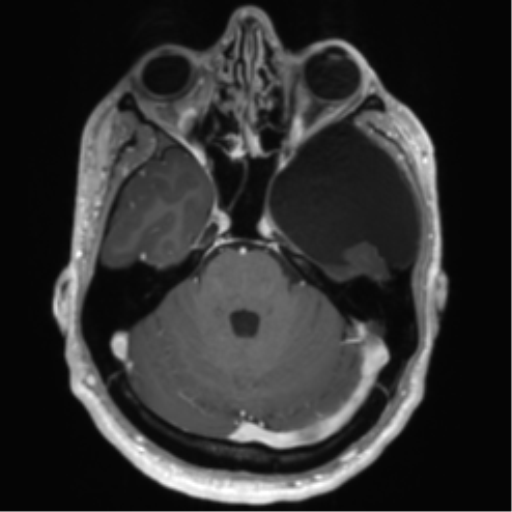 File:Arachnoid cyst with subdural hematoma (Radiopaedia 85892-101743 Axial T1 C+ 28).png