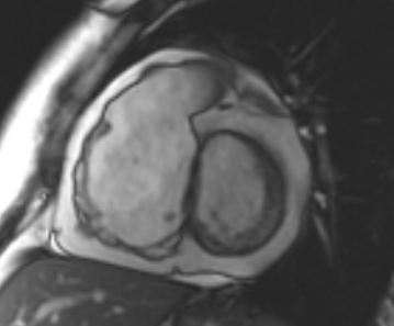 File:Arrhythmogenic right ventricular cardiomyopathy (Radiopaedia 69431-79307 Short axis cine 178).jpg