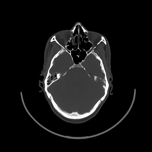 File:Arrow injury to the brain (Radiopaedia 72101-82607 Axial bone window 60).jpg
