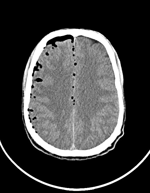 Arrow injury to the brain (Radiopaedia 72101-82607 Axial non-contrast 79).jpg