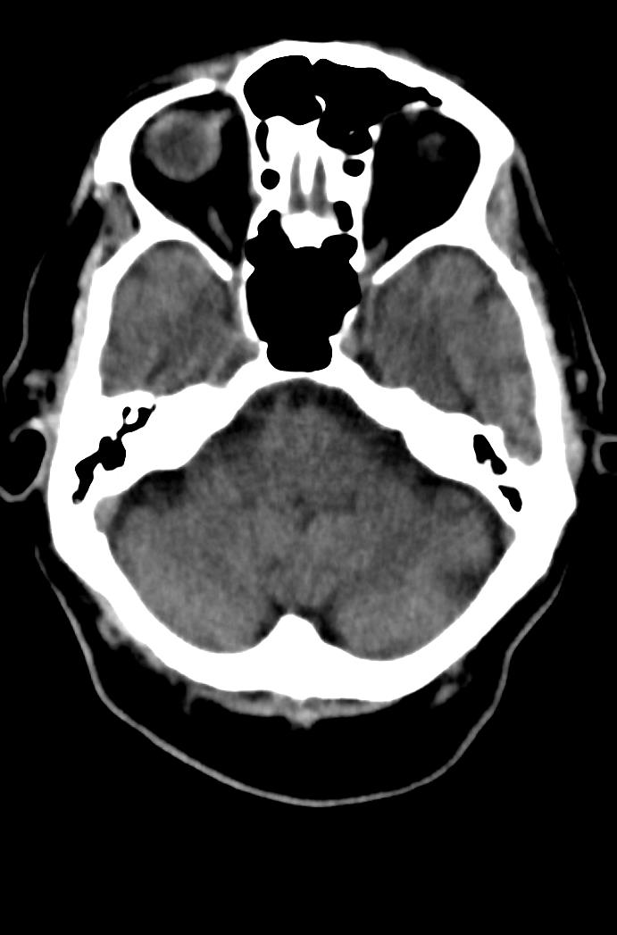Artery of Percheron infarction (Radiopaedia 80613-94202 Axial non-contrast 54).jpg
