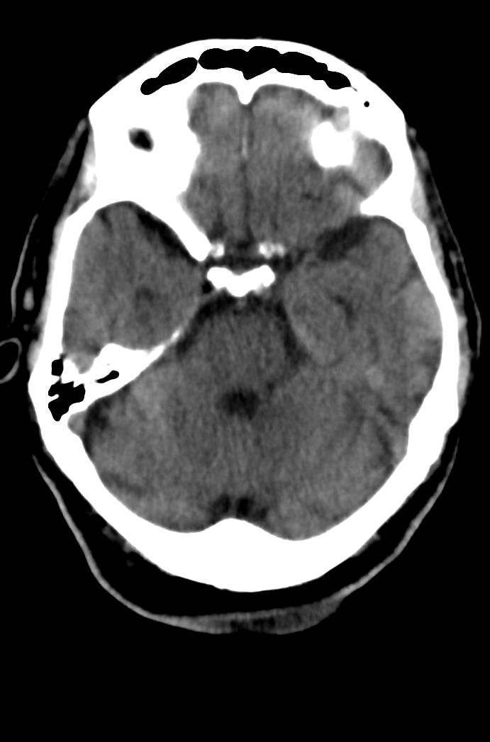 Artery of Percheron infarction (Radiopaedia 80613-94202 Axial non-contrast 66).jpg