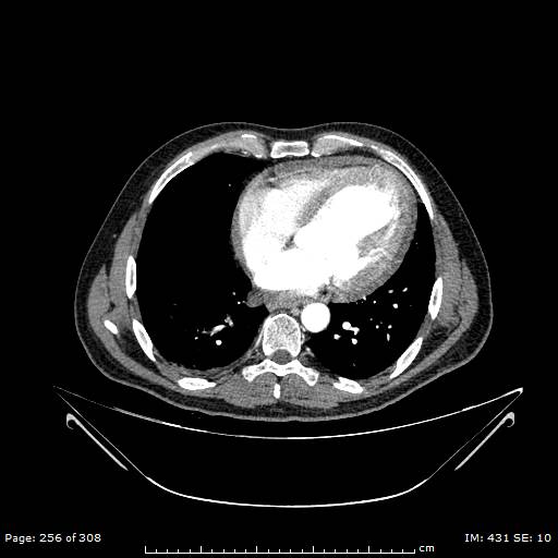 Ascending aortic aneurysm (Radiopaedia 50086-55404 A 64).jpg