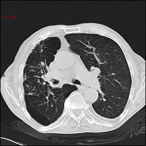 File:Aspergilloma (Radiopaedia 14842-14787 Axial lung window 20).jpg