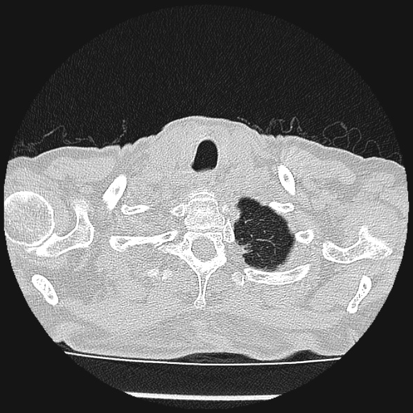 Aspergilloma (Radiopaedia 24458-24763 Axial lung window 4).jpg