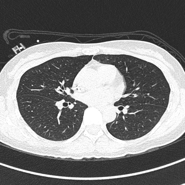 File:Aspergilloma (Radiopaedia 26223-26347 Axial lung window 41).jpg