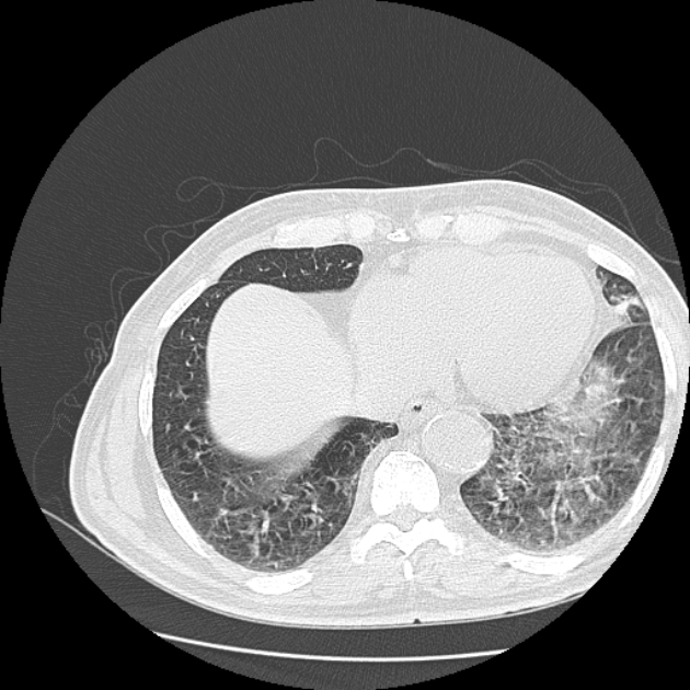 Aspergilloma (Radiopaedia 44592-48327 Axial lung window 71).jpg