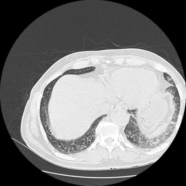Aspergilloma (Radiopaedia 44592-48327 Axial lung window 75).jpg