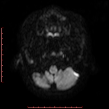 File:Astroblastoma (Radiopaedia 74287-85162 Axial DWI 2).jpg