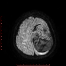 Astroblastoma (Radiopaedia 74287-85162 Axial DWI 88).jpg