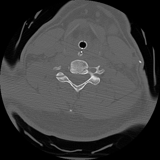 Atlanto-occipital dissociation injury (Radiopaedia 29274-29698 Axial bone window 49).png