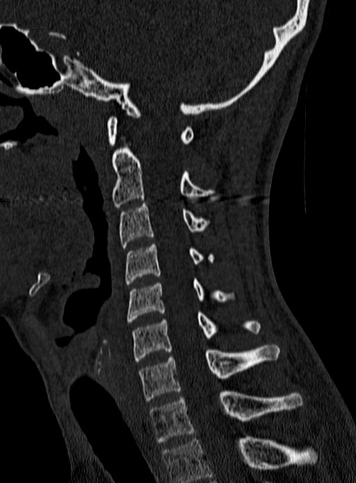 Atlantoaxial subluxation (Radiopaedia 44681-48450 Sagittal bone window 88).jpg