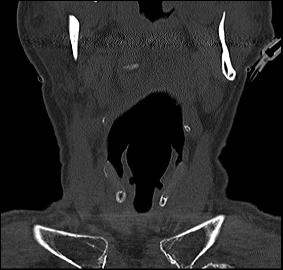 File:Atlas (type 3b subtype 1) and axis (Anderson and D'Alonzo type 3, Roy-Camille type 2) fractures (Radiopaedia 88043-104607 Coronal bone window 11).jpg