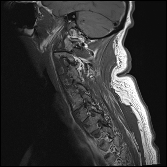 File:Atlas (type 3b subtype 1) and axis (Anderson and D'Alonzo type 3, Roy-Camille type 2) fractures (Radiopaedia 88043-104610 Sagittal T1 11).jpg