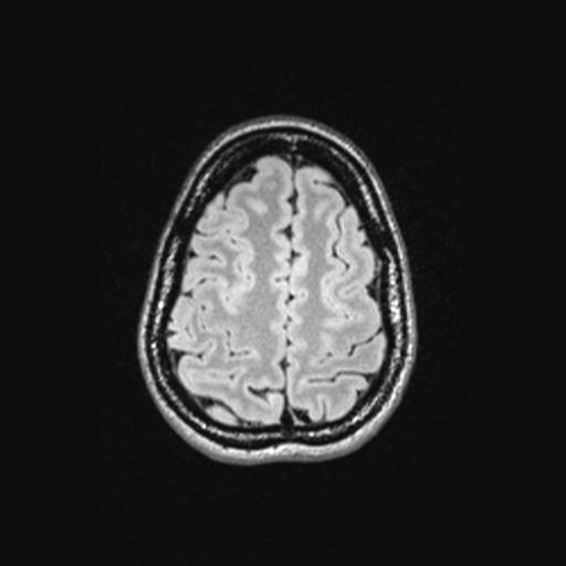 Atretic encephalocoele with inferior vermis hypoplasia (Radiopaedia 30443-31108 Axial 128).jpg